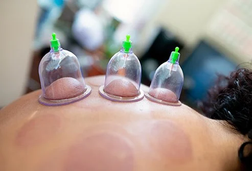 cupping traditional chinese medicine